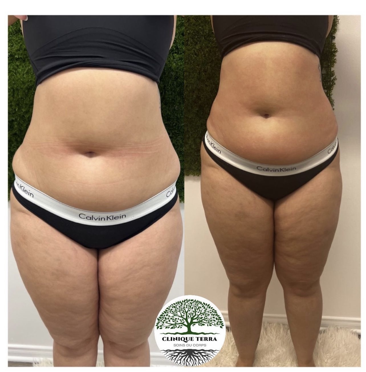 Lipocavitation / Radiofréquence / Amincissement