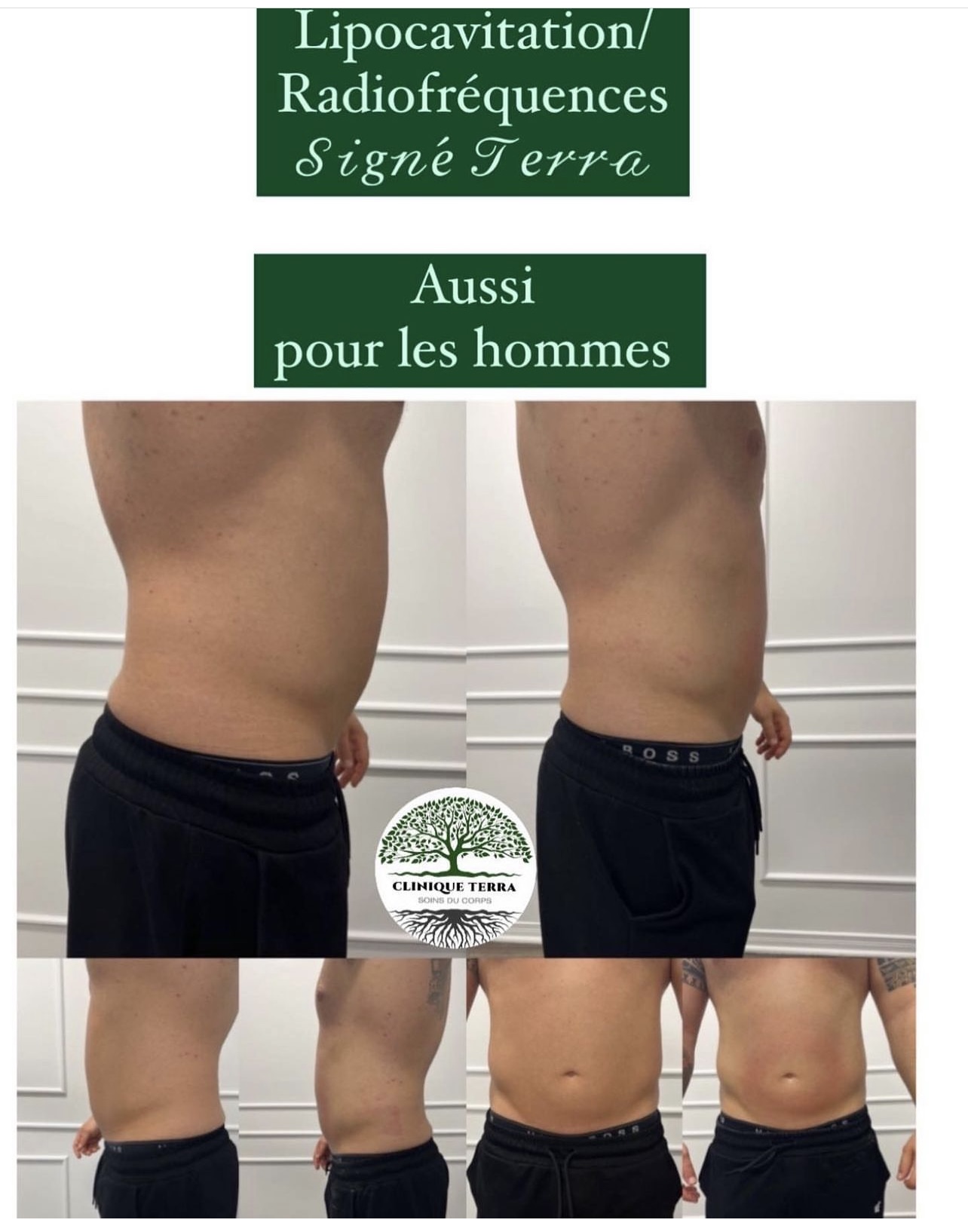 Lipocavitation & radiofréquence - Clinique Terra